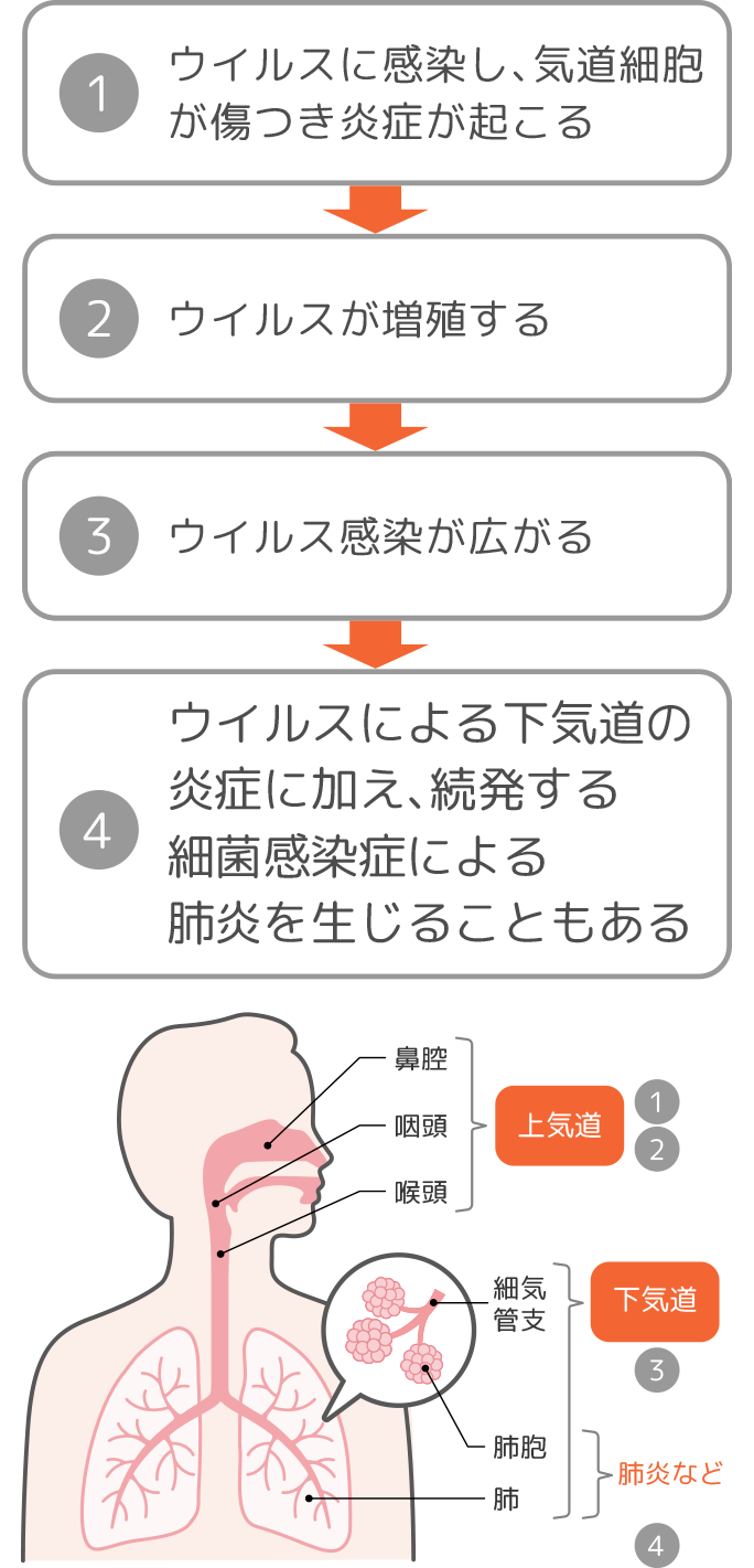 ウイルス感染は、肺炎などの下気道感染症を引き起こすきっかけ